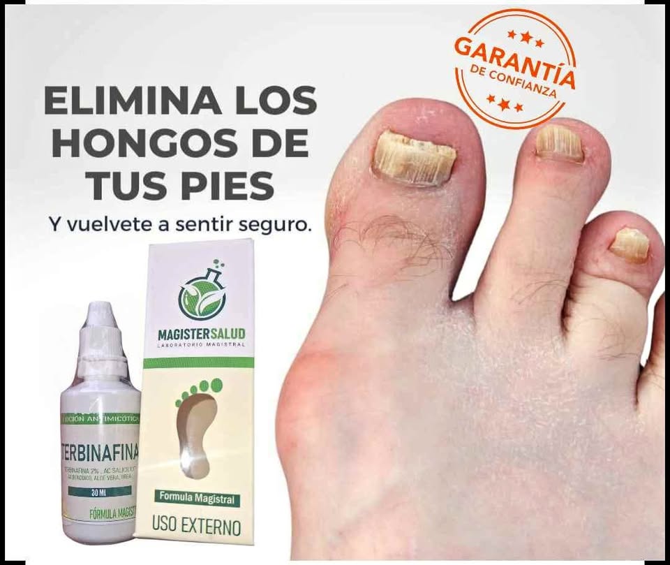 ADIOS HONGOS!! TERBINAFINA!!